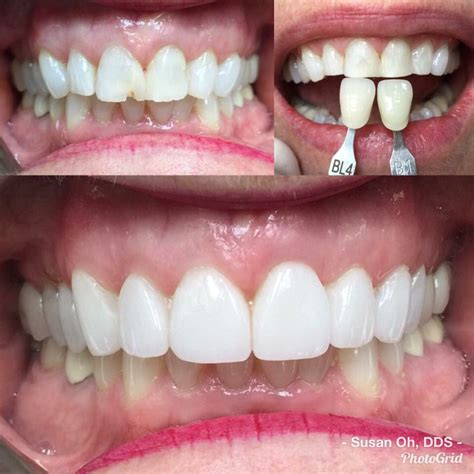 front teeth veneers.